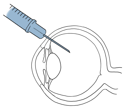 intravitreale Injektion